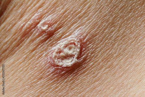 Scabs from inflammatory skin diseases photo