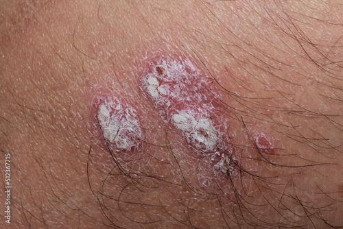 Scabs from inflammatory skin diseases