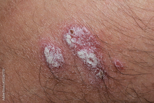 Scabs from inflammatory skin diseases photo