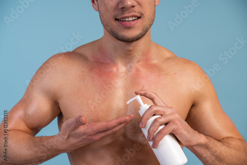 Close up view of the caucasian man with red sunburned skin applying cream against blue background. Stock photo