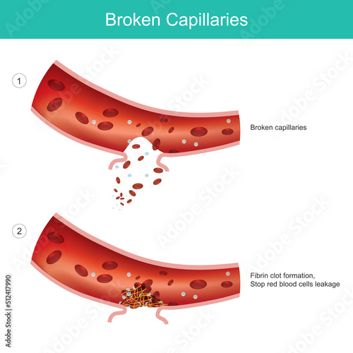 Broken capillaries. caused from blood capillaries expand too much.