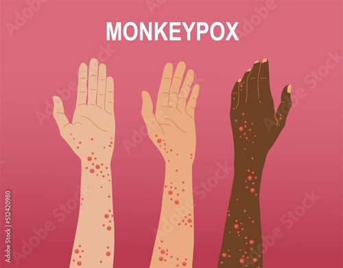 Monkey Pox hand collection. Illustration of Monkeypox symptoms