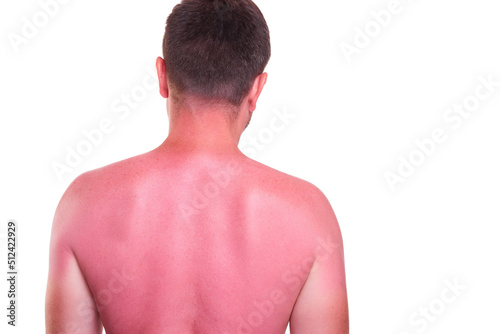фотографія Man with sunburnt back on white background