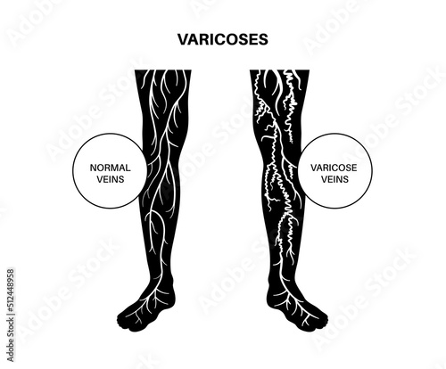 Varicose veins treatment