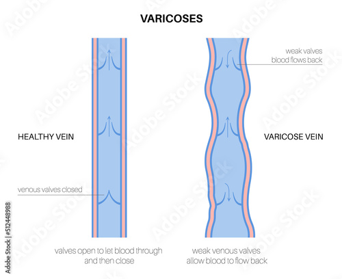 Varicose veins treatment