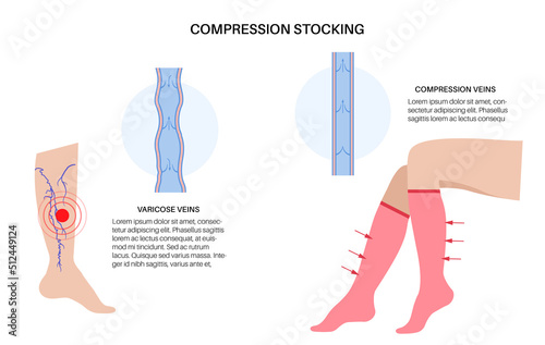 Compression stocking pressure