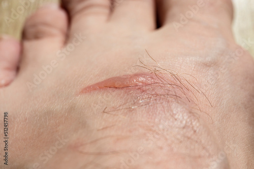 Close up of a blister on a mans foot
