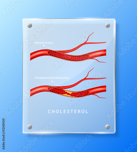 Cholesterol in human blood vessels inside square translucent glass panels for pharmacy advertisement. Poster banner design for clinics, hospital. Medic science concept. Realistic 3D Vector.