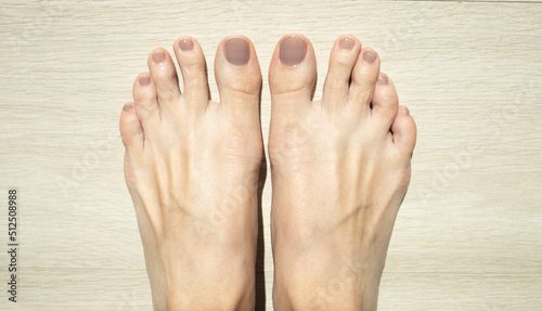 female feet of a girl 30 years old with a pedicure. Diseases of the legs, nails, joints. Pedicure at home, beauty, care.