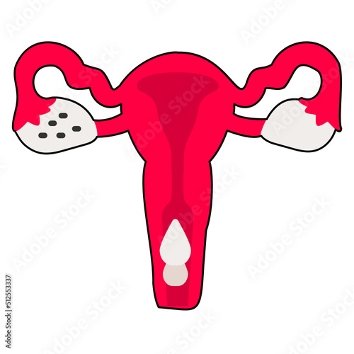 Extremely heavy period Vector color Icon Design, In Vitro Fertilization Symbol, Pregnancy and obstetrician Sign, test tube baby procedure stock illustration, Abnormal Uterine Bleeding Concept