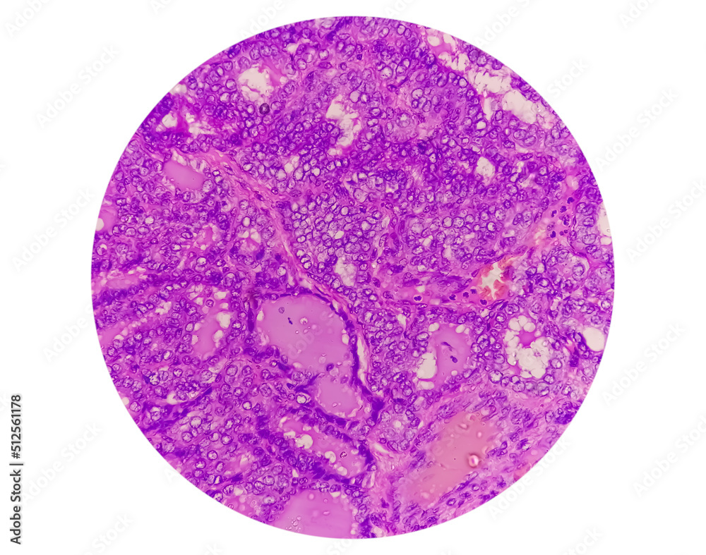 Thyroid cancer: Microscopic image of Metastatic papillary carcinoma of thyroid, central lymph node. Thyroid cancer: Microscopic image of Metastatic papillary carcinoma of thyroid, central lymph node.