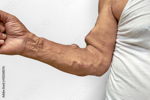 Arteriovenous fistula in the right forearm of hemodialysis patient.