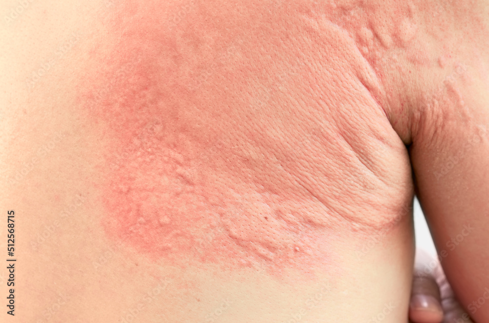 Fototapeta premium Close up image of a man's skin texture suffering severe urticaria or hives.