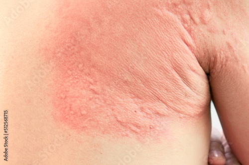 Close up image of a man s skin texture suffering severe urticaria or hives.