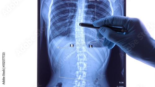Doctor analyzing X ray of the spine showing scoliosis in the lumbar area. Scoliosis is an abnormal lateral curvature of the spine. Dolly shot 4k