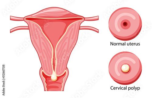 Set of Cervical Polyp in the uterus Female reproductive system in cross section and cervix view normal and with diseases. Human anatomy internal organs location scheme vulva flat style icon