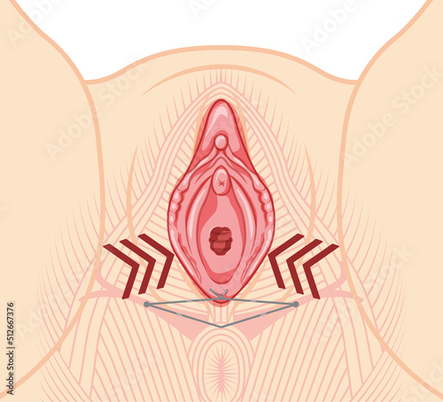 Vaginal lifting with threads Female reproductive system of external genital organs. Front view. Human Surface anatomy of the perineum vulva external organs location scheme, vagina flat style icon