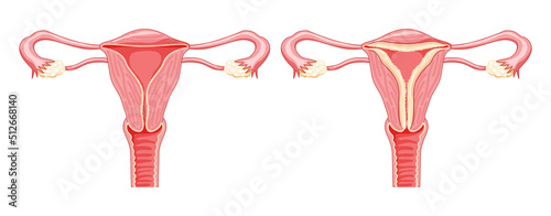 Set of Endometrial hyperplasia Female reproductive system in normal and problem uterus. Front view in a cut. Human anatomy internal organs diseases location scheme flat style icon photo