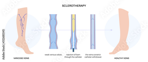 Varicose Injection procedure photo