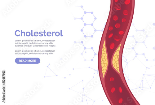 Cholesterol artery thrombosis micro vascular desease. Arteriosclerosis blood vector atherosclerosis risk