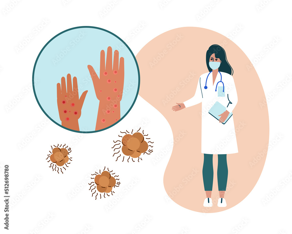 Monkeypox symptoms concept cartoon vector illustration. Monkeypox symptoms concept cartoon vector illustration.