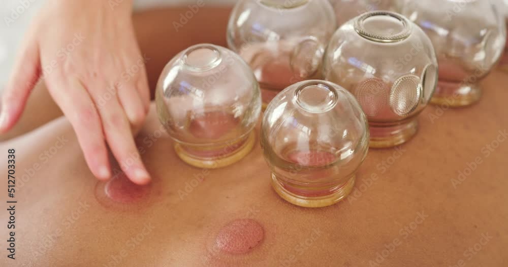 Therapist using cupping therapy to treat patient in clinic. Professional placing glass cups along the back for blood circulation and healing. Releasing muscle tension with a holistic gentle treatment Therapist using cupping therapy to treat patient in clinic. Professional placing glass cups along the back for blood circulation and healing. Releasing muscle tension with a holistic gentle treatment