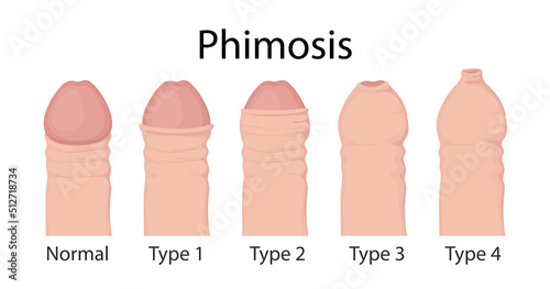 Types of phimosis. penis medical vector illustration. photo