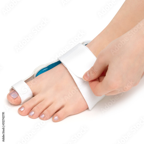 orthosis for bunions, hallux valgus on the woman's foot