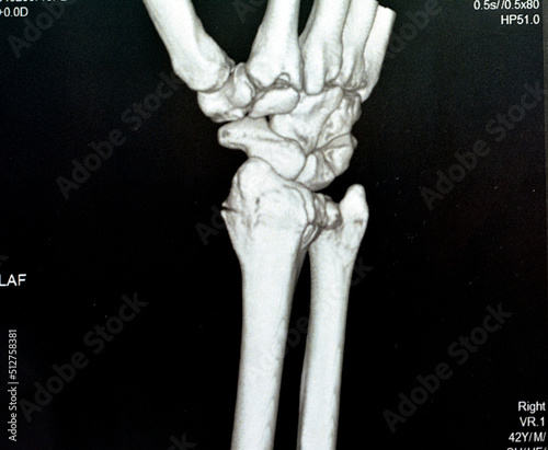 CT scan right wrist joint 3D view shows right distal radius fracture for closed reduction and cast, selective focus of a CAT scan imaging showing fracture radius bone after direct trauma to the wrist