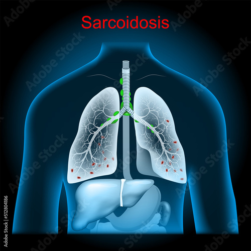 Sarcoidosis. Enlarged lymph nodes in the lungs