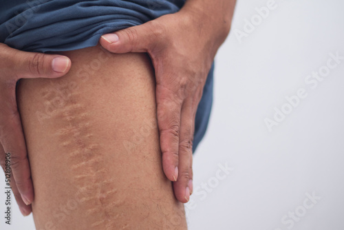 Scar caused by leg surgery