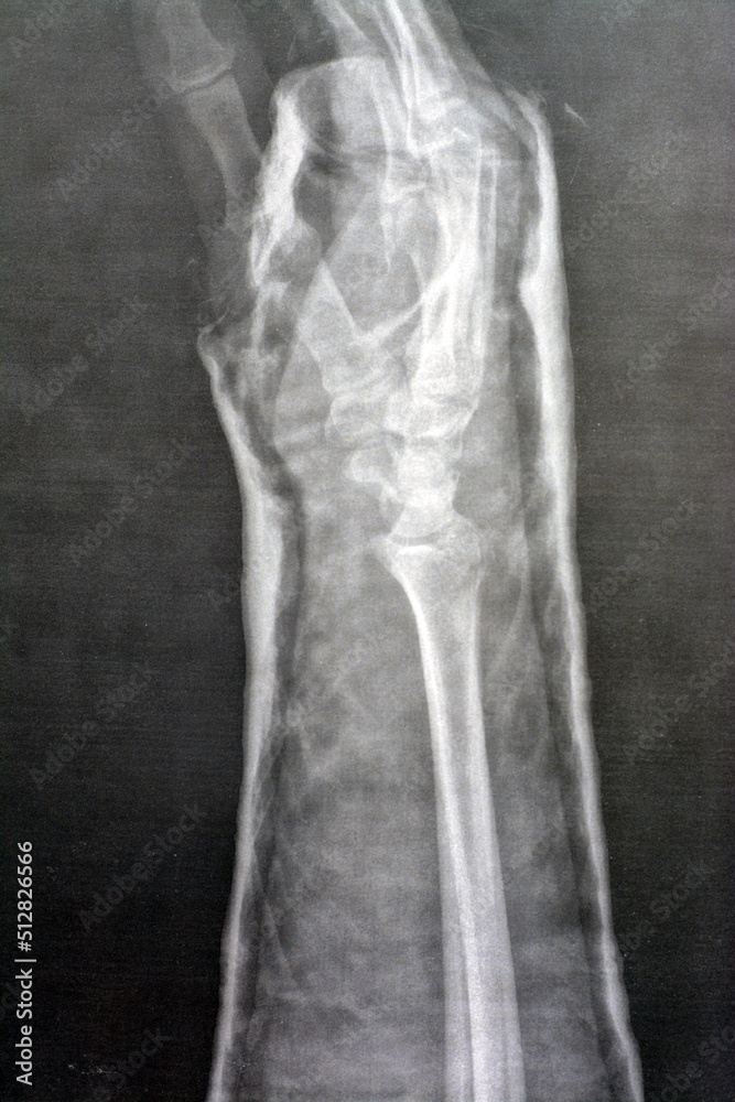 Plain x ray right wrist joint shows right distal radius fracture ...