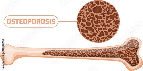 Osteoporosis bone clipart design illustration photo