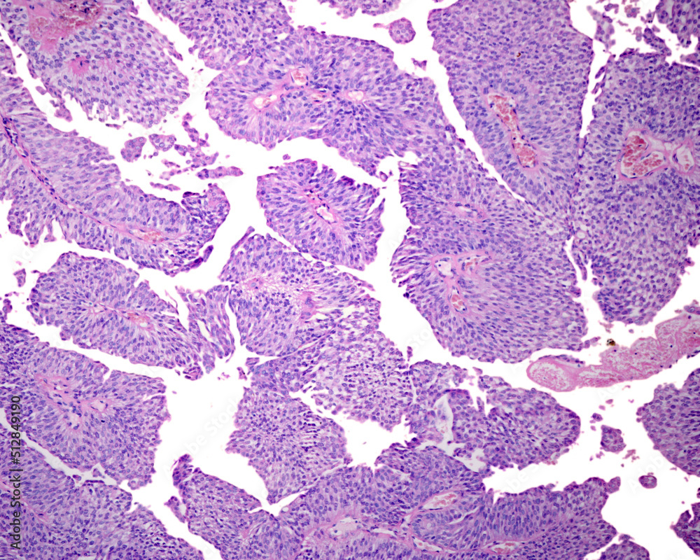 Human urinary bladder. Papillary carcinoma Stock Photo | Adobe Stock