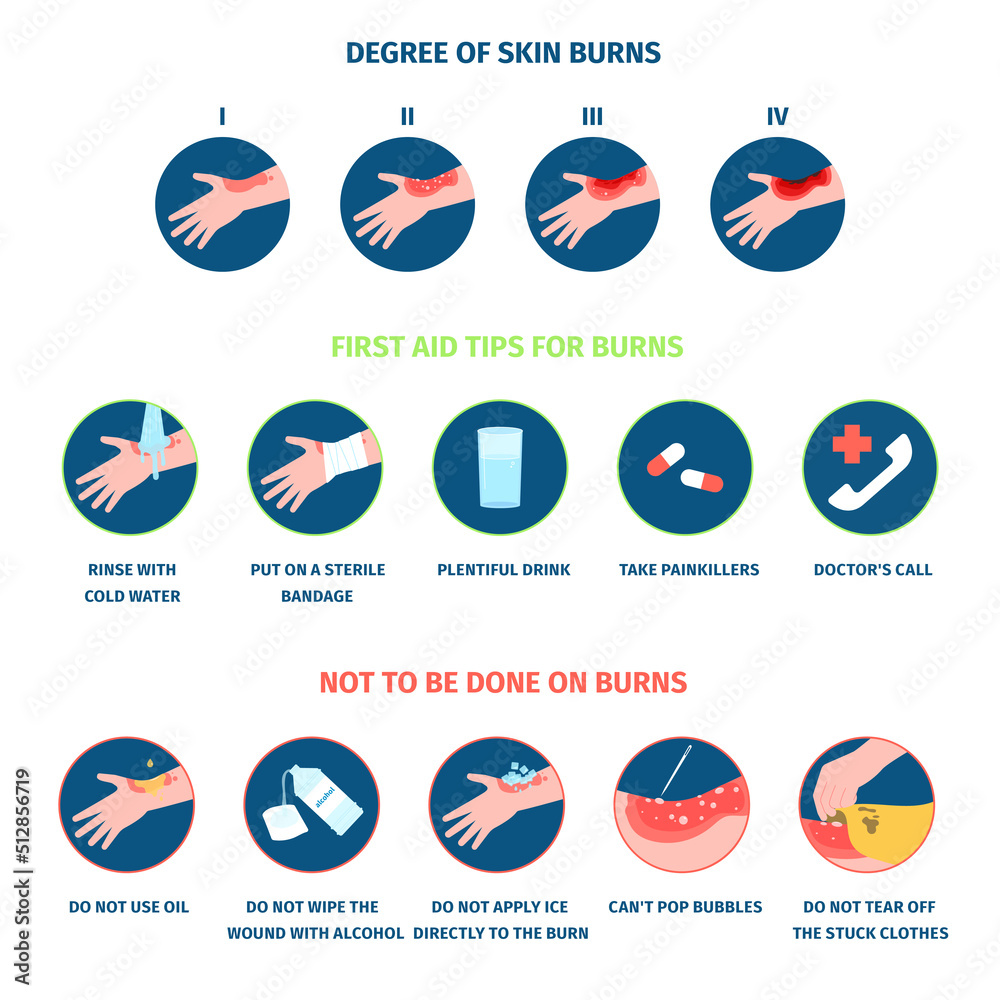 Skin burn stages infographics and treatment. Thermal burns types, burning hands and medical care. Safety of fire, body skin first aid an injury recent vector poster - obrazy, fototapety, plakaty 