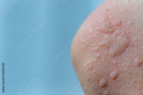 Urticaria on the skin. Red spots of an allergic reaction on the skin of a child. Urticaria symptoms close up photo