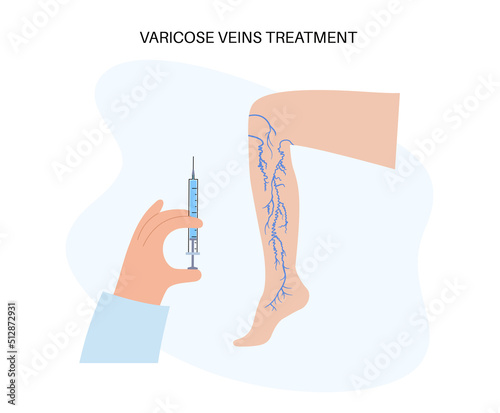 Varicose Injection procedure