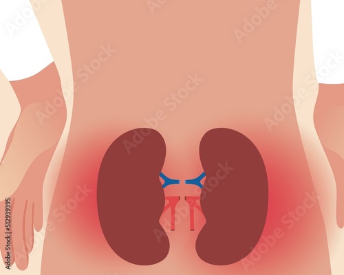 Kidney disease, anatomical vector stock illustration with persona and pyelonephritis disease
