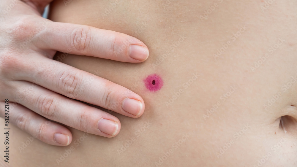 Close-up of a removed wart on a woman's abdomen. Human papillomavirus after burning.