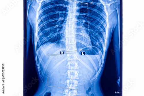 X ray showing scoliosis of the lumbar spine
