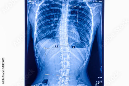 X ray showing scoliosis of the lumbar spine