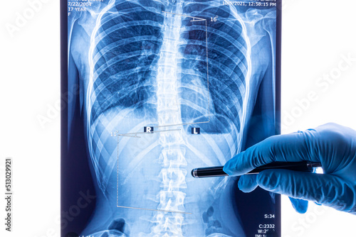 Doctor analyzing X ray of the spine showing scoliosis in the lumbar area