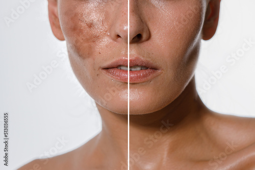 Hyperpigmentation of female skin, close-up of a part of the face on a white background, before and after acid peeling and cosmetic therapy, dermatology, skin care photo