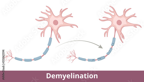 Demyelination process. Protective covering (myelin sheath) that surrounds nerve fibers is damaged due to demyelinating diseases like multiple sclerosis, optic neuritis, transverse myelitis.