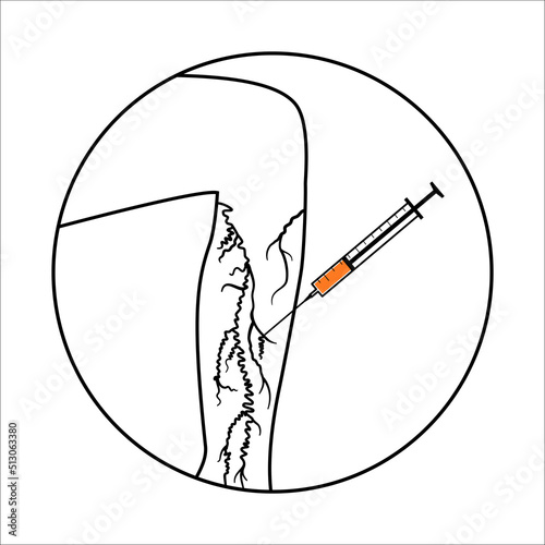 Varicose Injection procedure photo