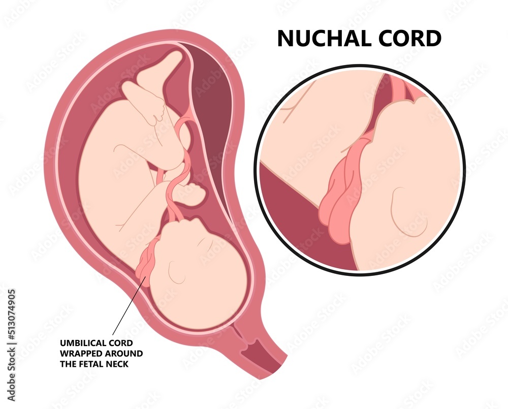 gestation distress abruption of Nuchal cord coil c section baby birth fetal neck and death Knot test born labor fluid Anemia womb fetus of Pre eclampsia Vasa previa accreta increta gestation distress abruption of Nuchal cord coil c section baby birth fetal neck and death Knot test born labor fluid Anemia womb fetus of Pre eclampsia Vasa previa accreta increta