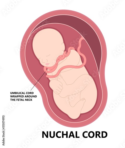 Nuchal cord coil and c section baby birth fetal neck of death born with Knot test labor fluid Anemia womb fetus Pre eclampsia by Vasa previa gestation distress abruption with accreta increta