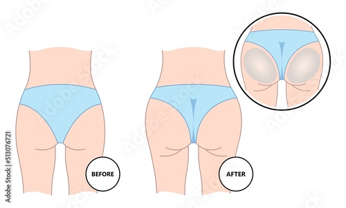 Back view of buttock enhancement augment surgery after graft Brazilian Butt lift