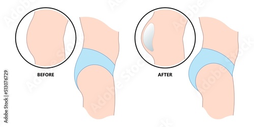 Side view of buttock enhancement augment surgery after graft Brazilian Butt lift with silicone implant