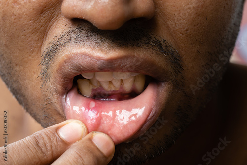 Painful mouth ulcer photo